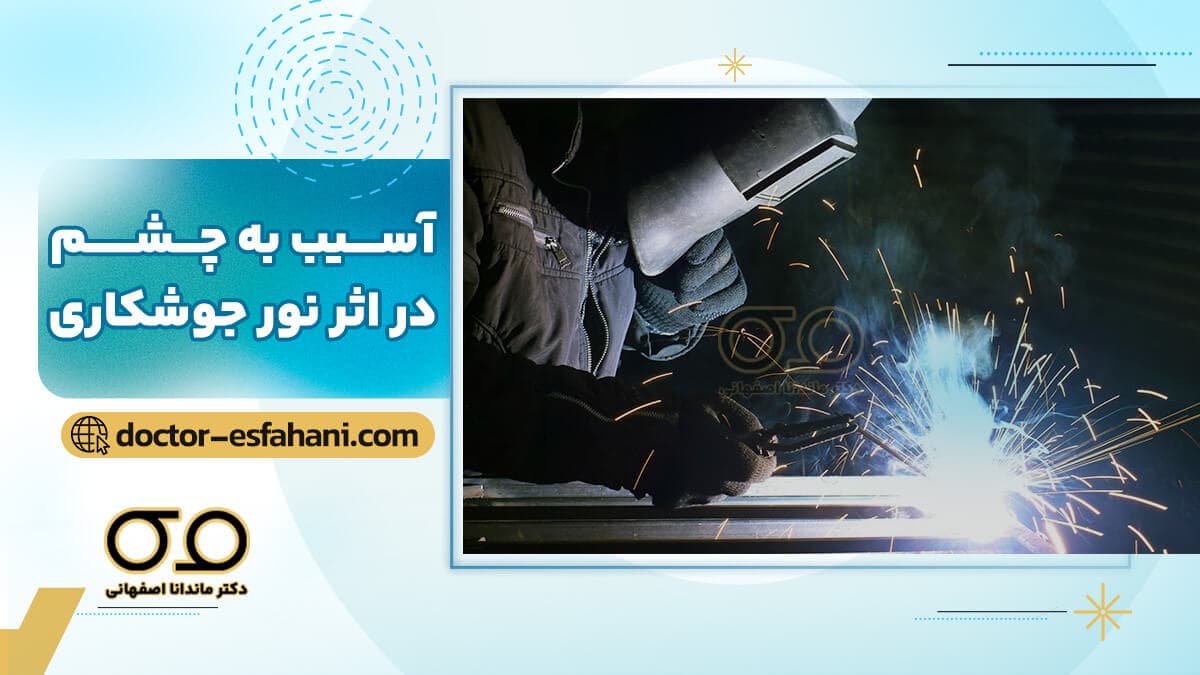 آسیب به چشم در اثر نور جوشکاری