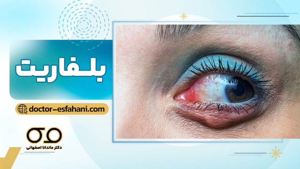 بلفاریت چیست؟