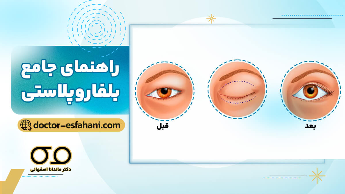 راهنمای عمل بلفاروپلستی