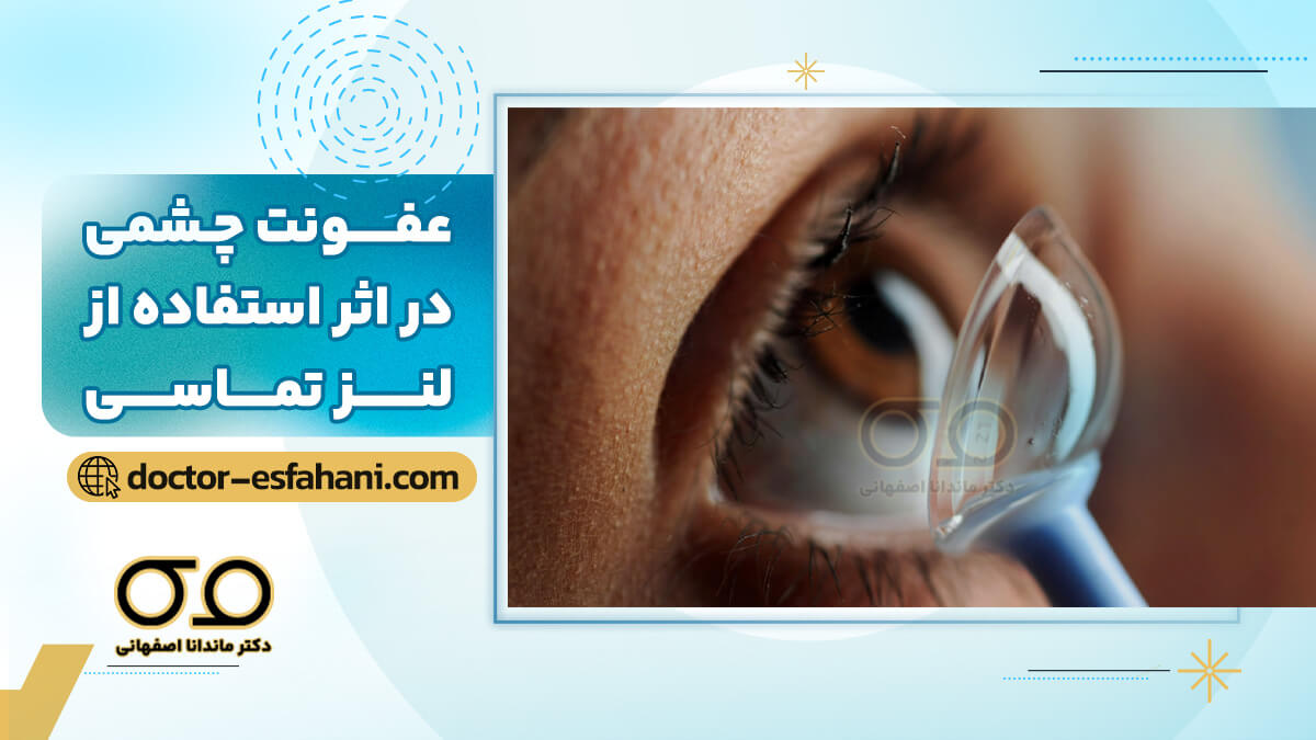 عفونت چشمی در اثر استفاده از لنز تماسی