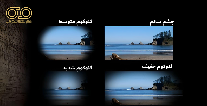 دید فرد مبتلا به گلوکوم