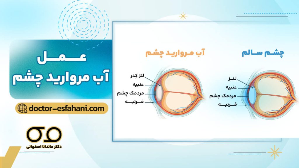 عکس جراحی کاتاراکت
