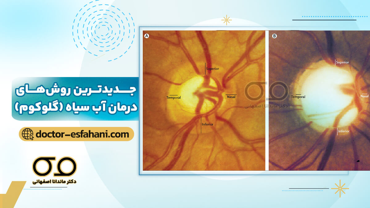جراحی پیچیده آب سیاه