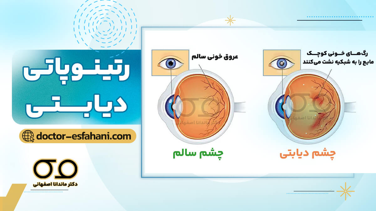 عکس رتینوپاتی دیابتی