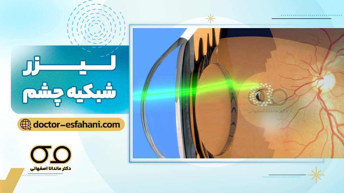 لیزر شبکیه چشم