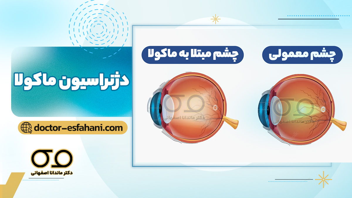 دژنراسیون ماکولا