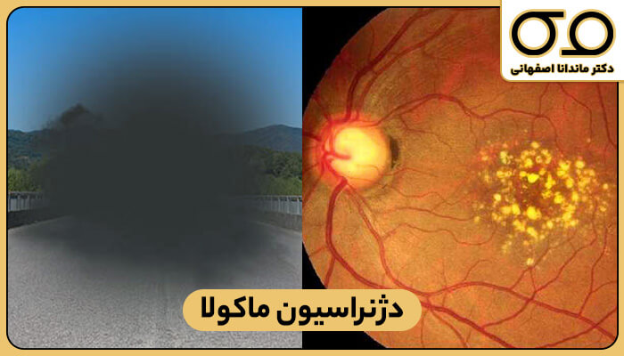 دید فرد مبتلا به دژنراسیون ماکولا