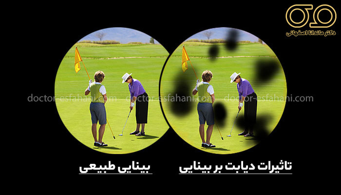 تاثیرات دیابت بر چشم ها