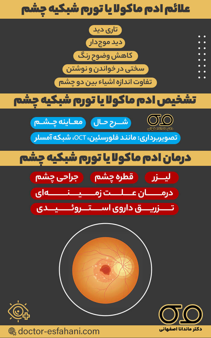 تشخیص و درمان ادم ماکولا