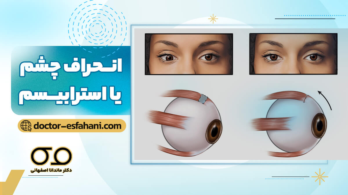 انحراف چشم یا استرابیسم