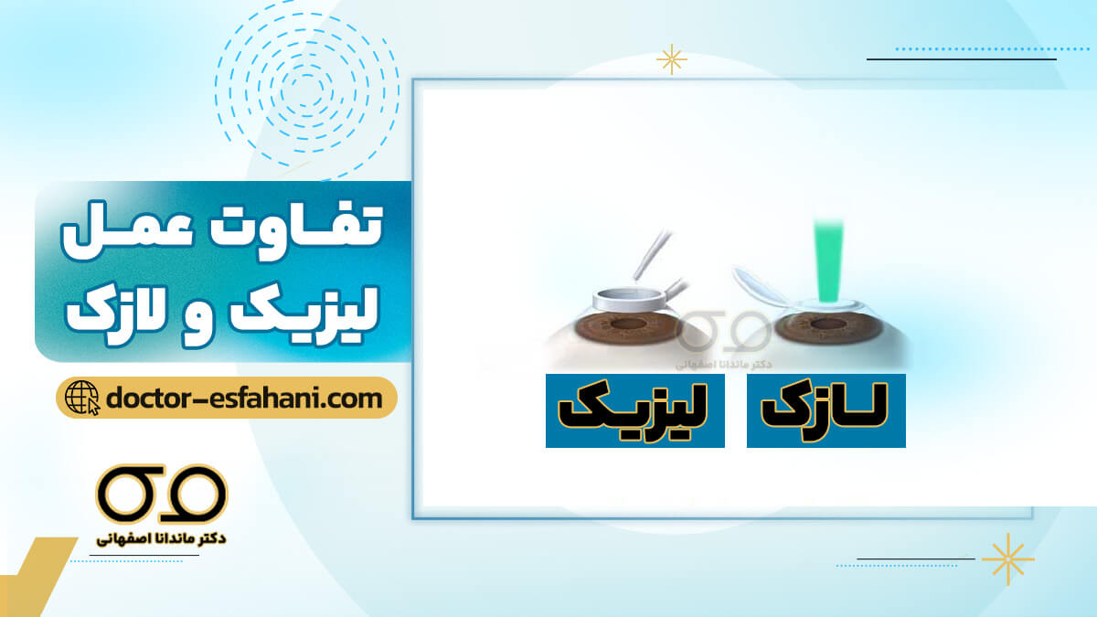 تفاوت لیزیک و لازک