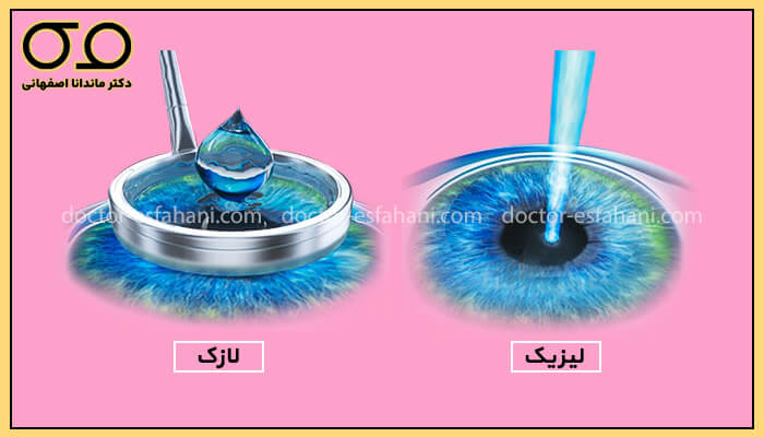 تصویر تفاوت همل لیزریک و لازک