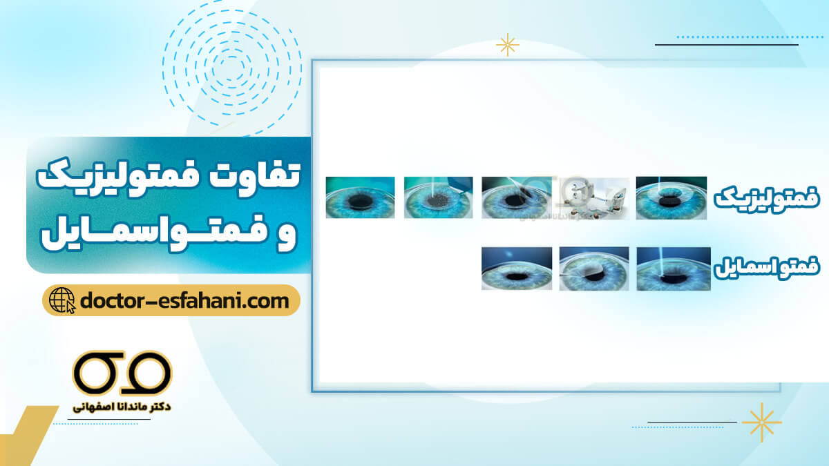 مقایسه فمتولیزیک و فمتو اسمایل