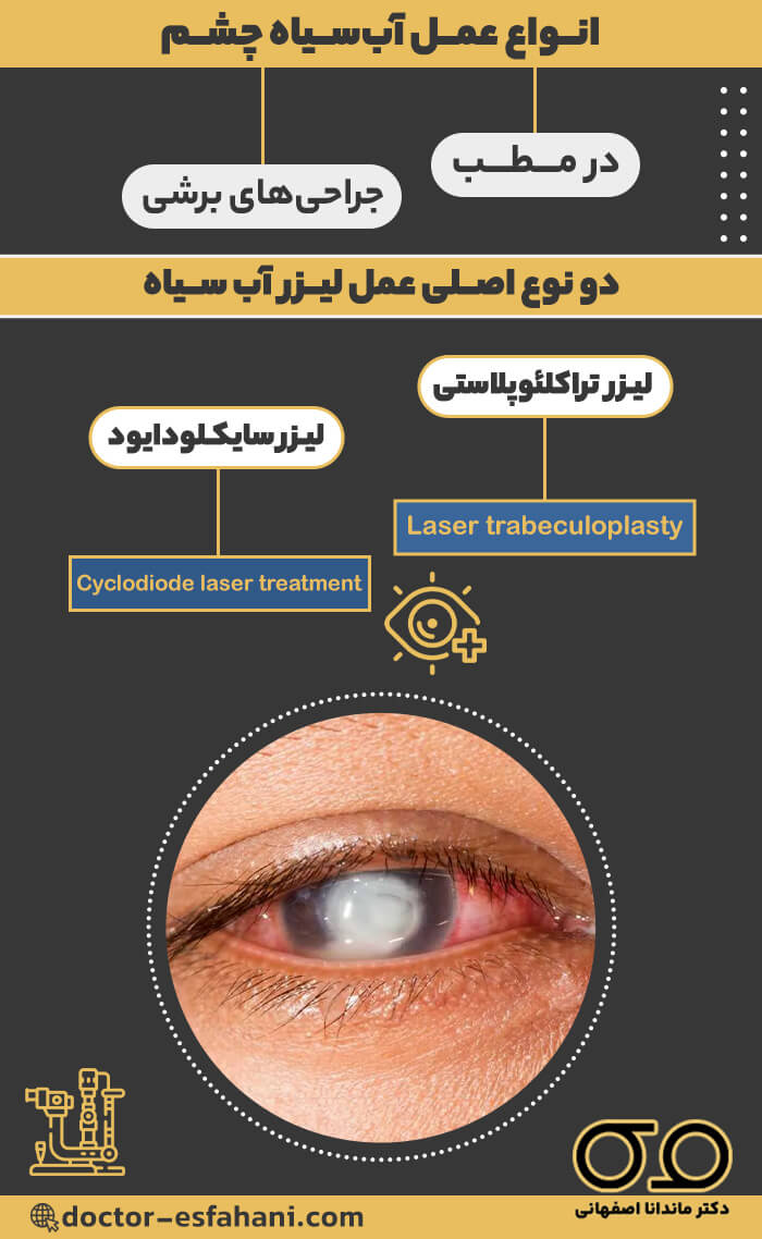تصویر گرافیکی انواع درمان آب‌سیاه چشم