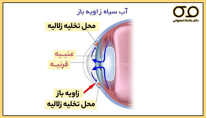 عکس چشم که دچار بیماری آب‌سیاه زاویه باز شده است. 