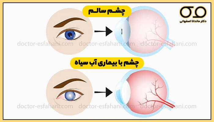 مقایسه چشم سالم و چشم با بیماری آب‌سیاه