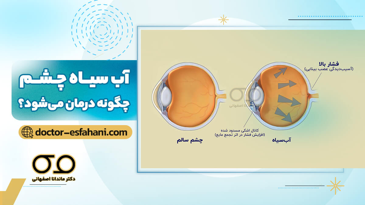 مقایسه چشم سالم و چشمی که دچار آب‌سیاه شده است.