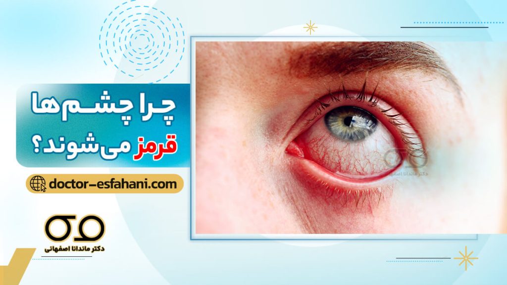 تصویر شاخص قرمزی چشم
