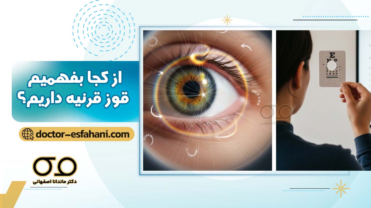 عکس قوز قرنیه