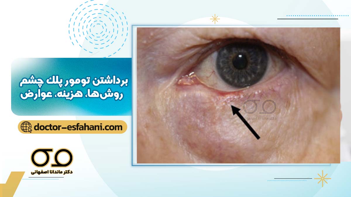 عکس تومور پلک چشم