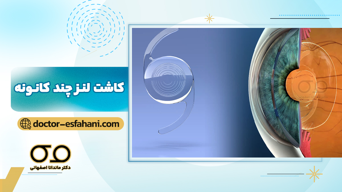 کاشت لنز چند کانونه